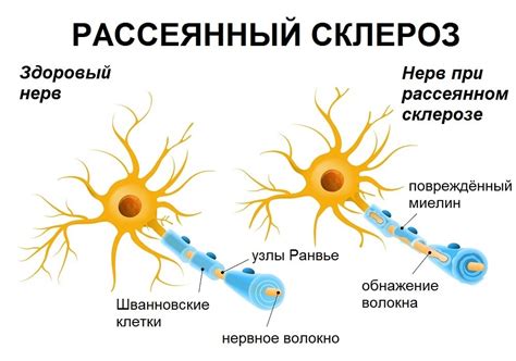 рассеянный склероз передается по наследству|Рассеянный склероз: что это такое и сколько с ним живут